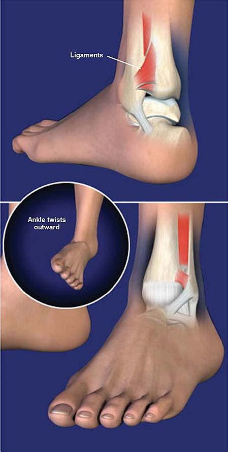 Syndesmotic ankle injury (high ankle sprain) 